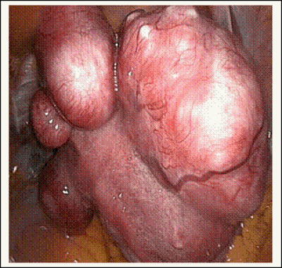 Ινομυώματα/ Πολύποδες