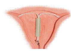 Αντισύλληψη