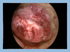 ινομυώματα της μήτρας